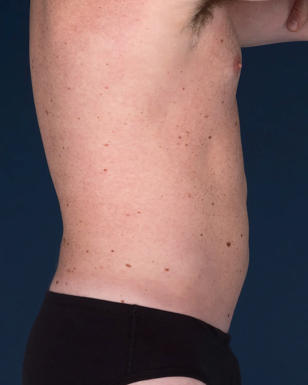 Coolsculpting Before & After
